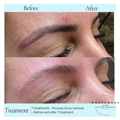 Eyebrow Tattoo Removal