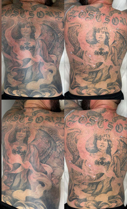 Tattoo Laser Removal