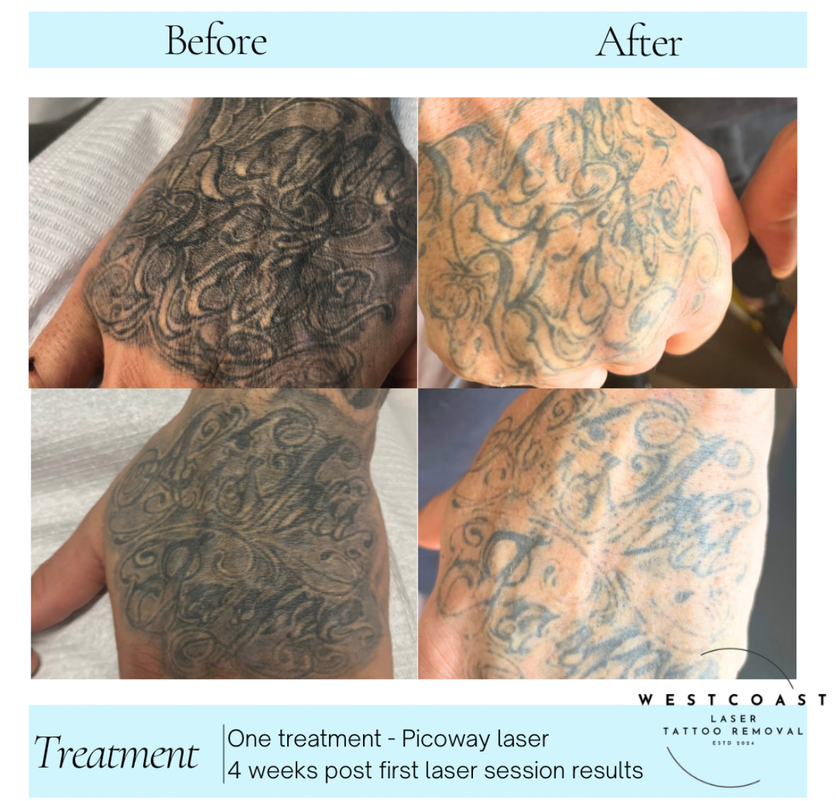 Tattoo Laser Removal