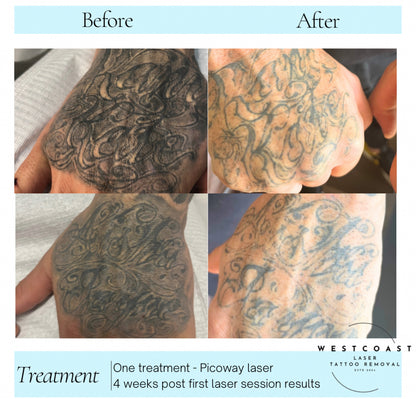 Tattoo Laser Removal