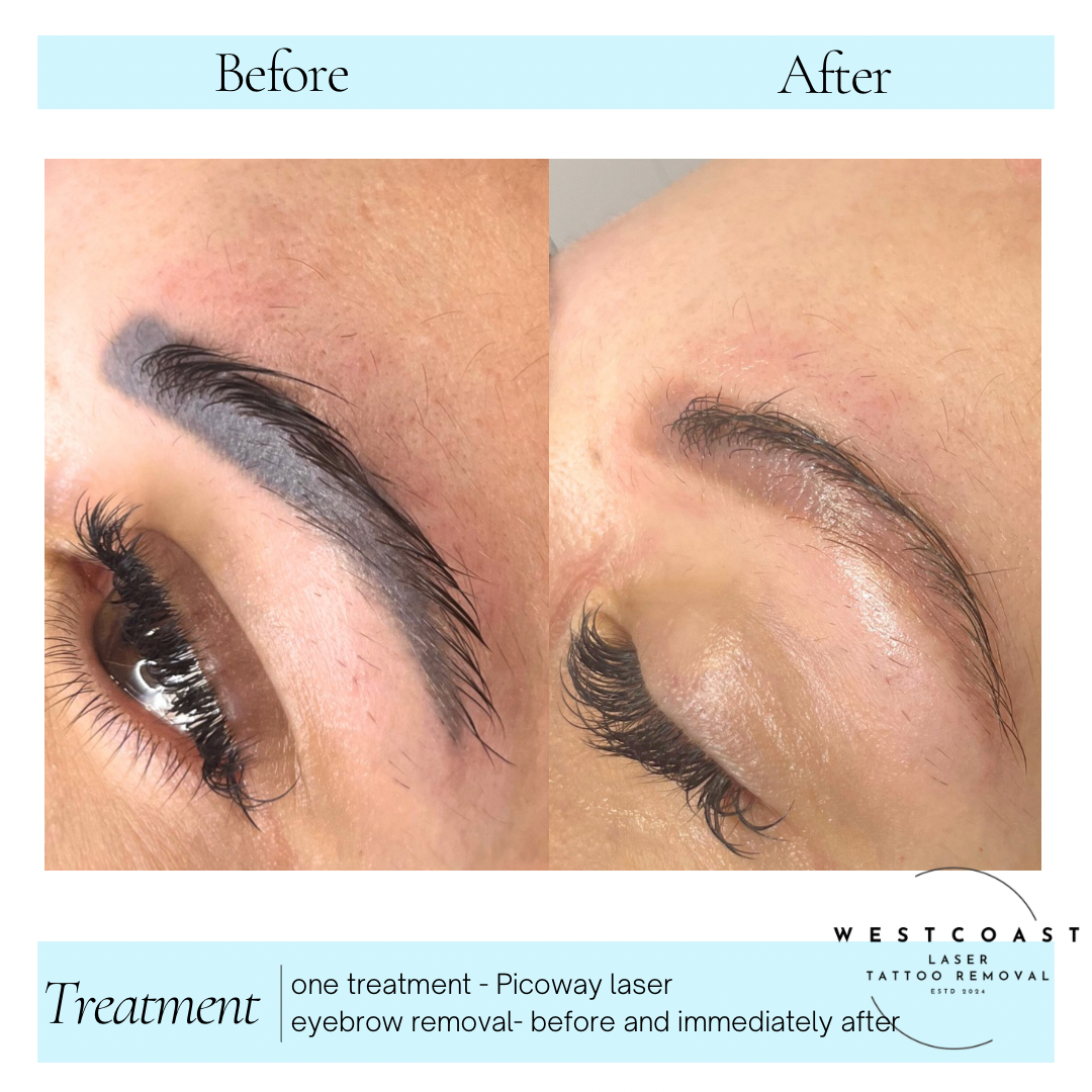 Eyebrow Tattoo Removal