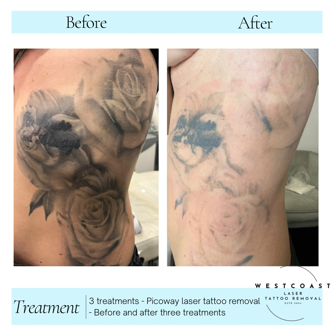 Tattoo Laser Removal