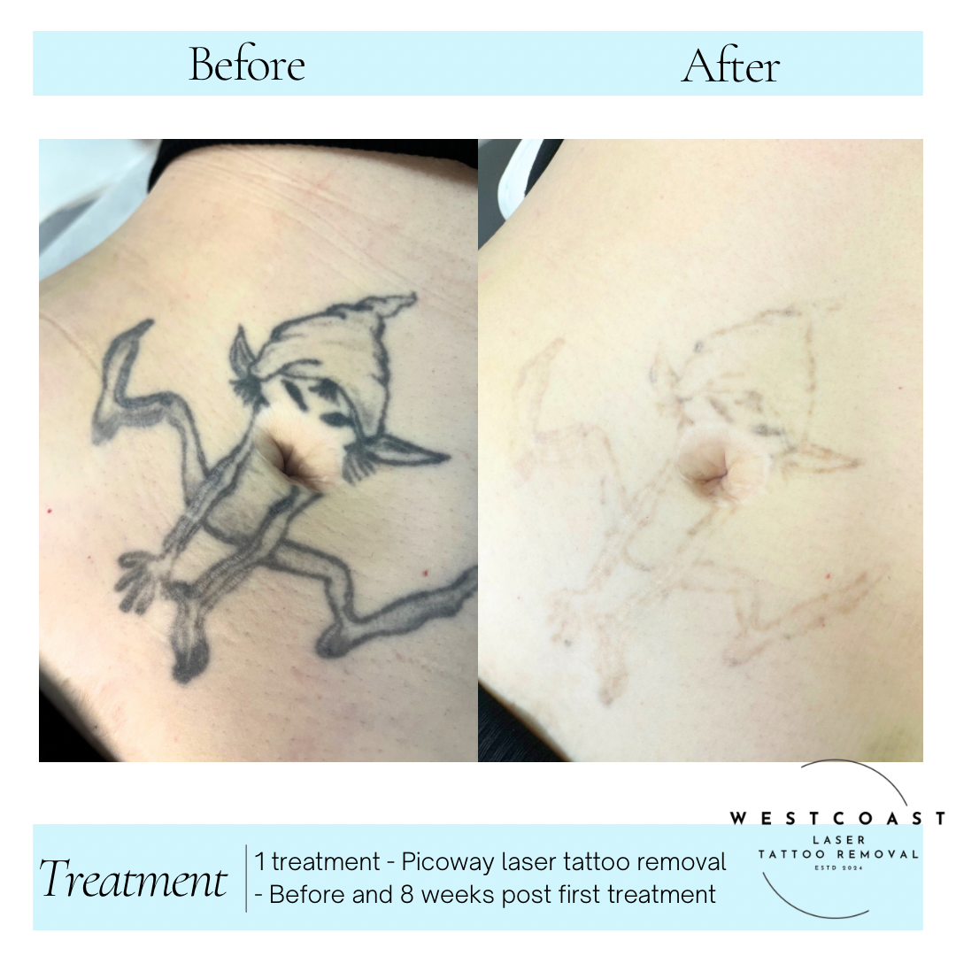 Tattoo Laser Removal