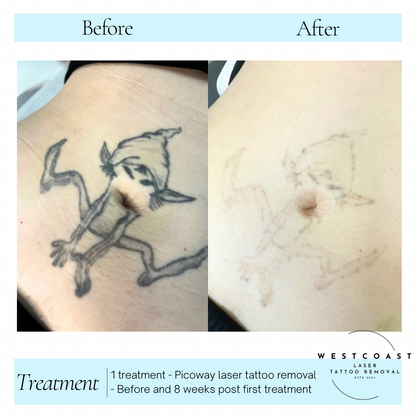 Tattoo Laser Removal