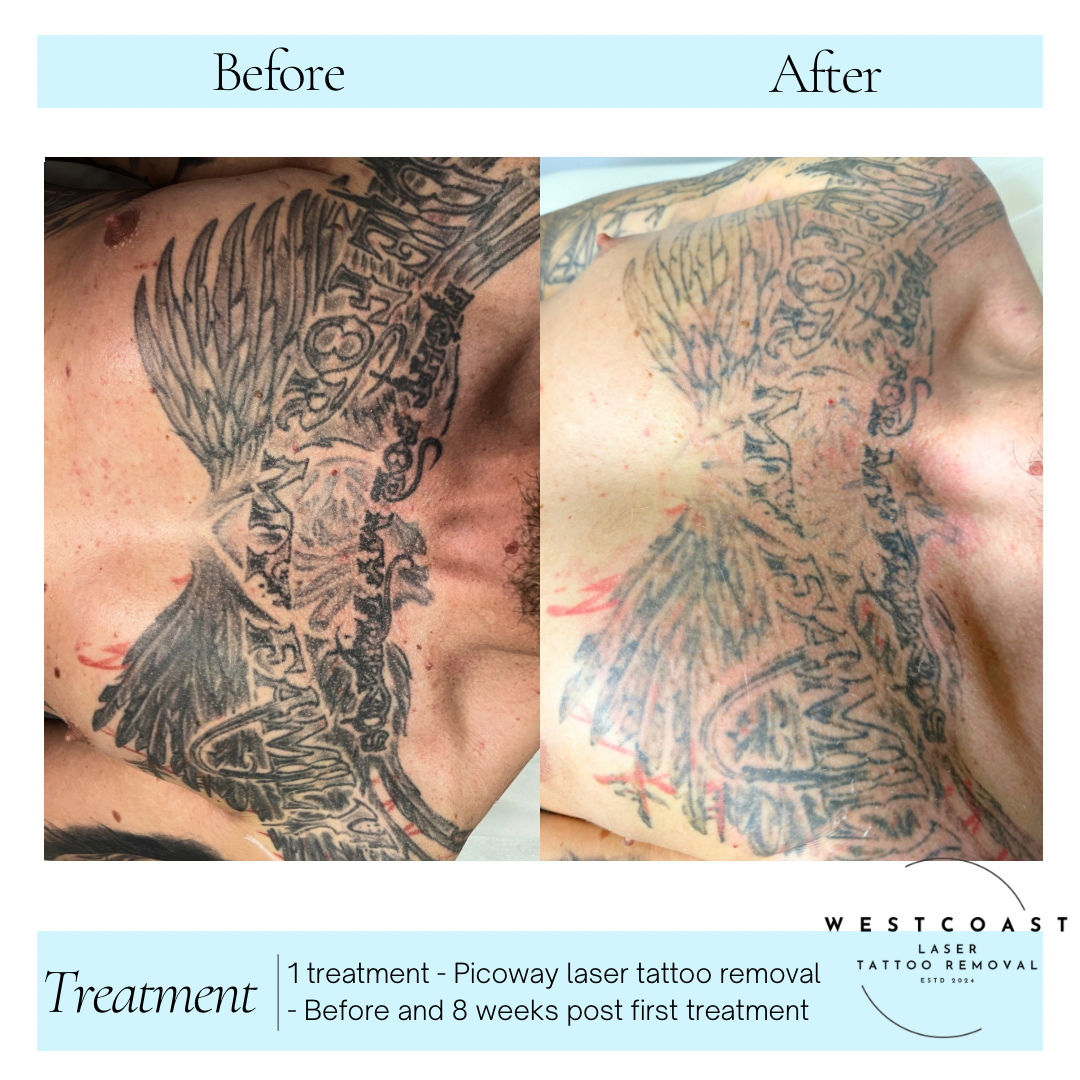 Tattoo Laser Removal