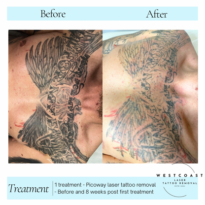 Tattoo Laser Removal
