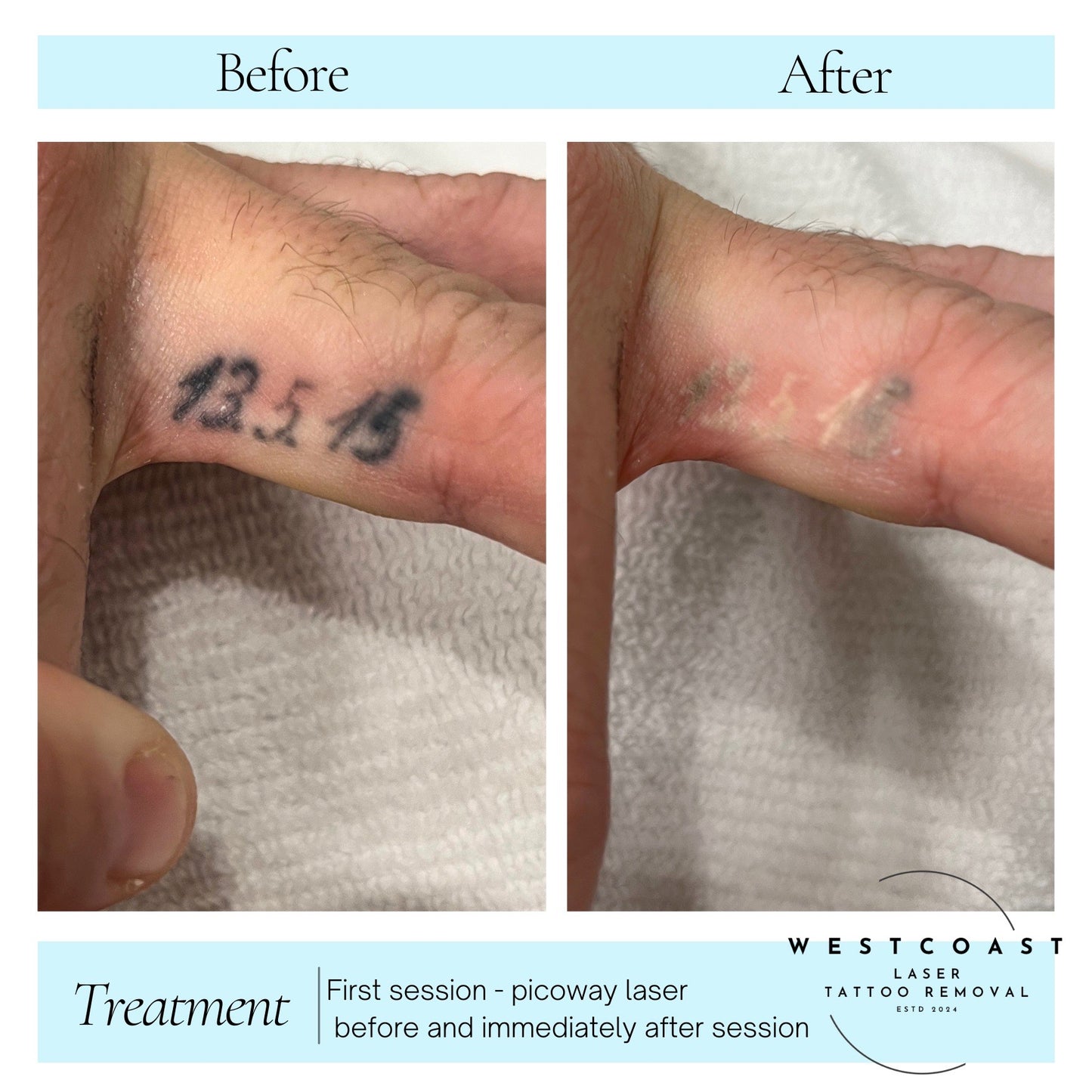 Tattoo Laser Removal