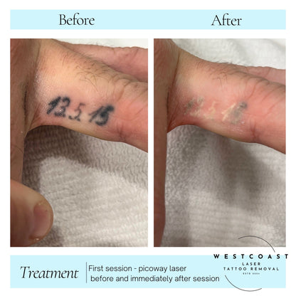 Tattoo Laser Removal