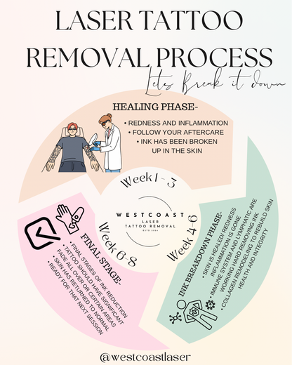 Tattoo Laser Removal