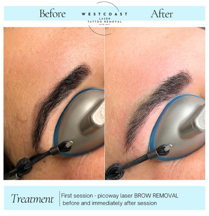 Eyebrow Tattoo Removal