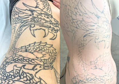 Tattoo Laser Removal