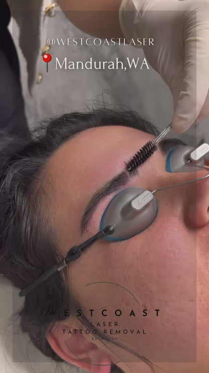 Eyebrow Tattoo Removal