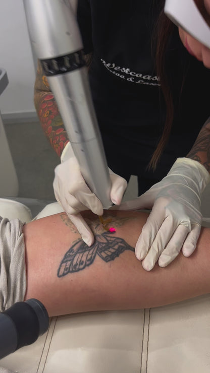 Tattoo Laser Removal