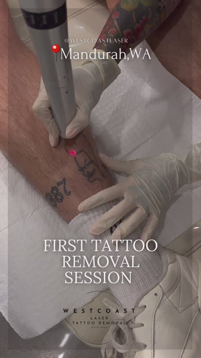 Tattoo Laser Removal