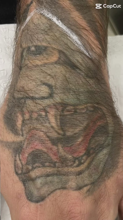 Tattoo Laser Removal